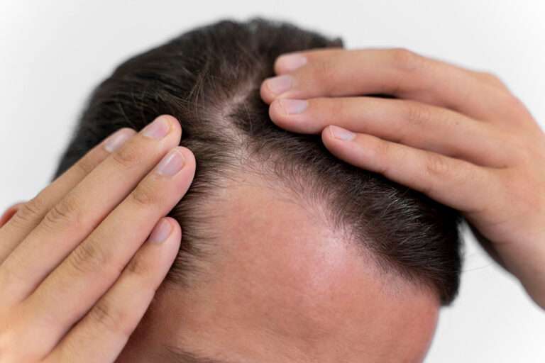 Hair loss is one of the most common problem